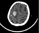 ICH Classification